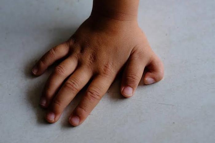 Why some people are born with 6 fingers