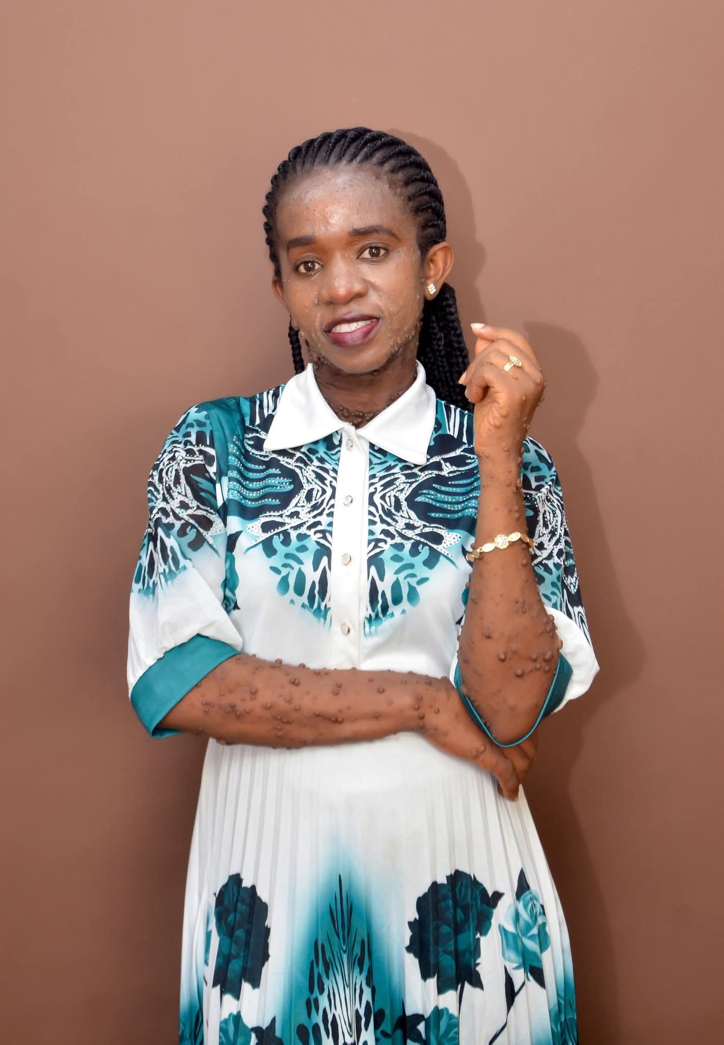Woman with skin condition shares discrimination she faces in church during 'sign of peace'