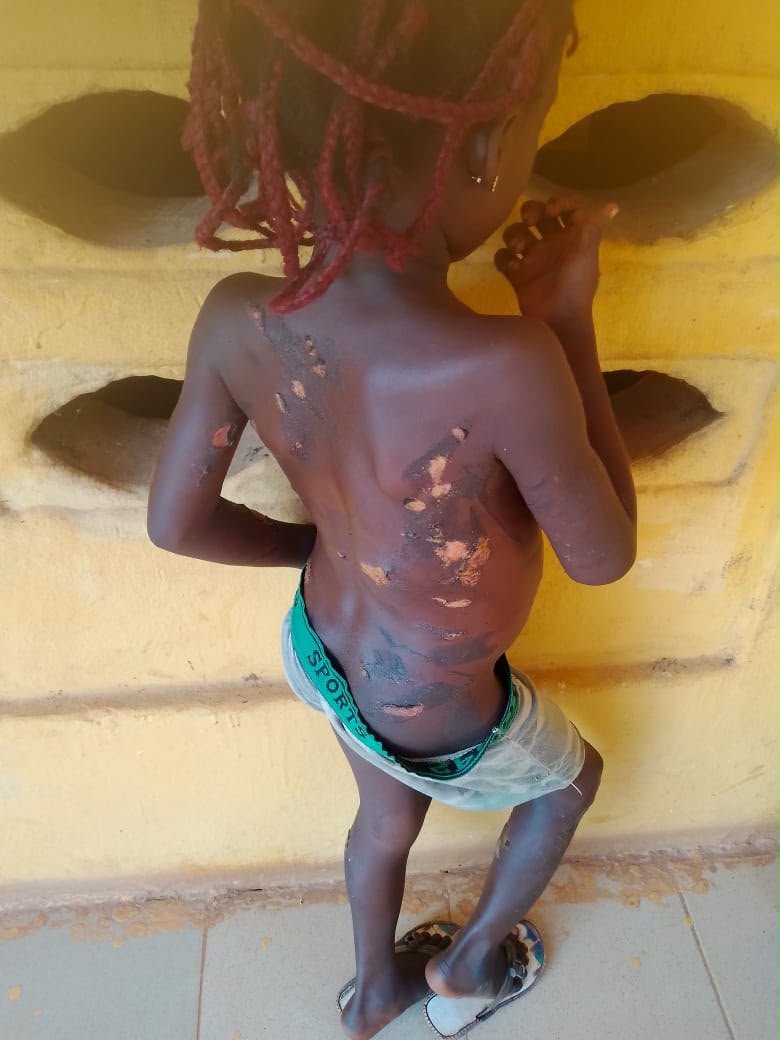 Anambra Security Arrest Woman For Brutalizing Her Little Child With Hot Knife