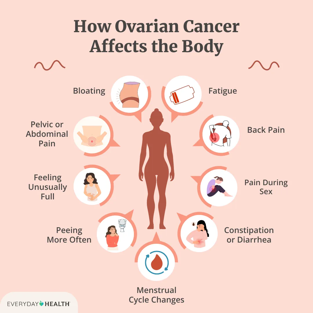 20172483_ehhowovariancanceraffectsthebodyseographics_webpbc9feda771ac8479ea3b966735bdcba8