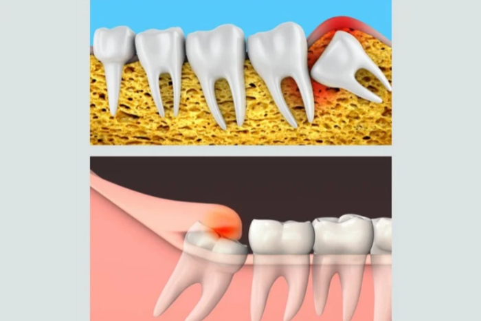 Teething isn’t just for babies: why wisdom teeth can cause trouble in your twenties